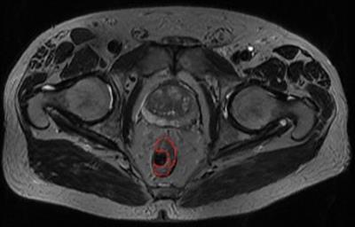 Downsizing of rectal cancer following neoadjuvant radiotherapy (5 × 5 Gy) and long interval surgery evaluated using MRI semiautomated volumetric measurements, a retrospective study